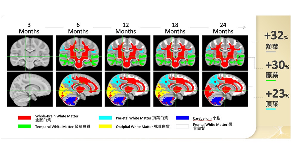 圖三：各月齡之嬰幼兒其額葉、顳葉、頂葉的腦髓鞘量，當實驗組顯著領先對照組的區塊，以顏色顯示。